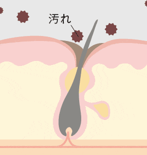 背中ニキビの原因は毛穴から汚れなどが入り込んで炎症を起こすため。