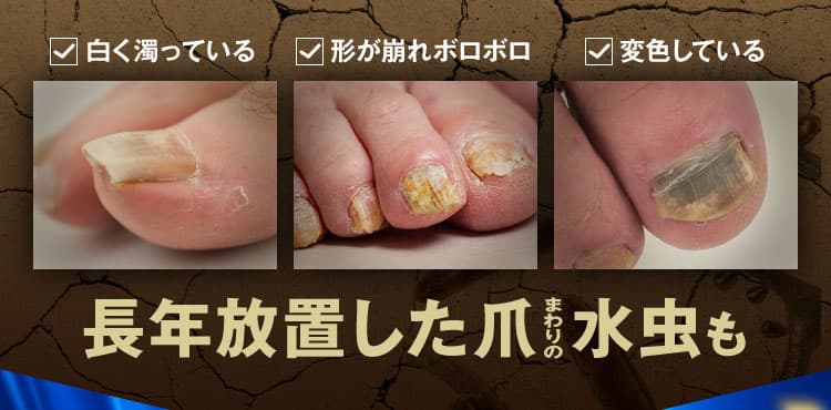 三ツ星クリアナチュラルで爪まわりを治療！