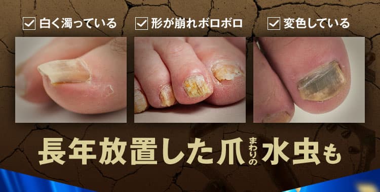 三ツ星クリアナチュラルで爪まわりを治療！