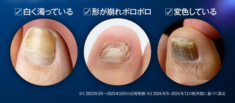三ツ星クリアナチュラルで爪まわりを治療！