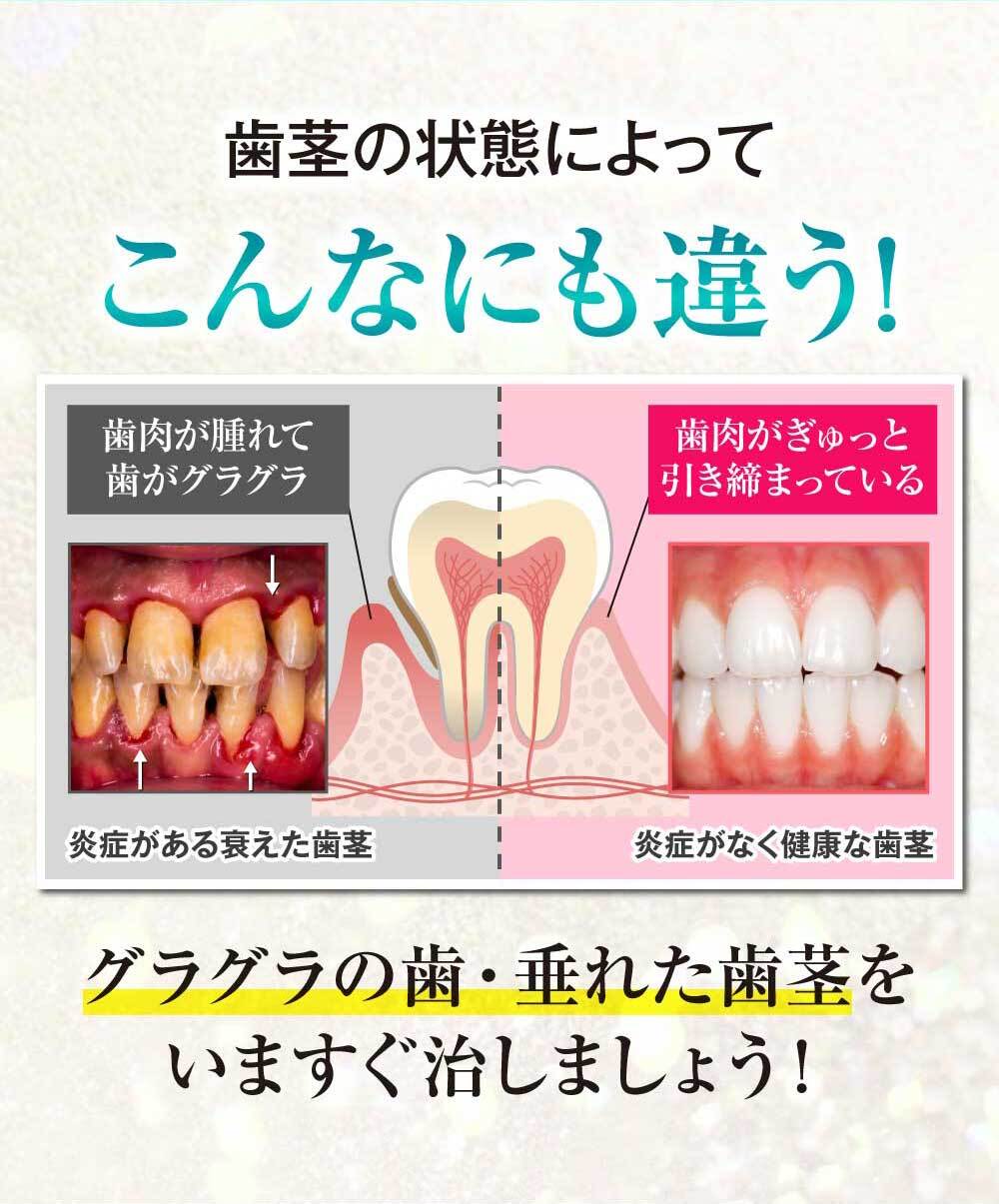 歯茎の状態によってこんなにも違う！