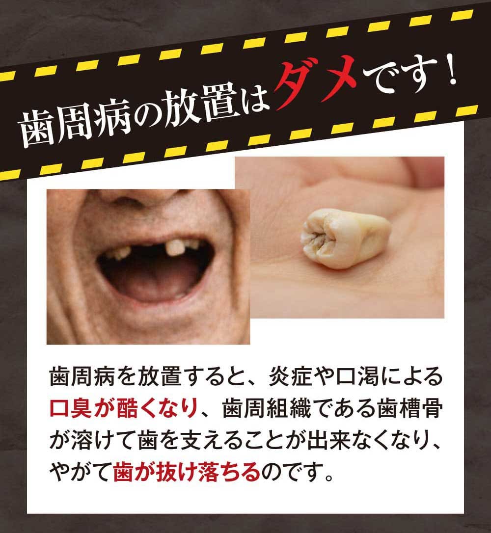 歯周病の放置はダメ