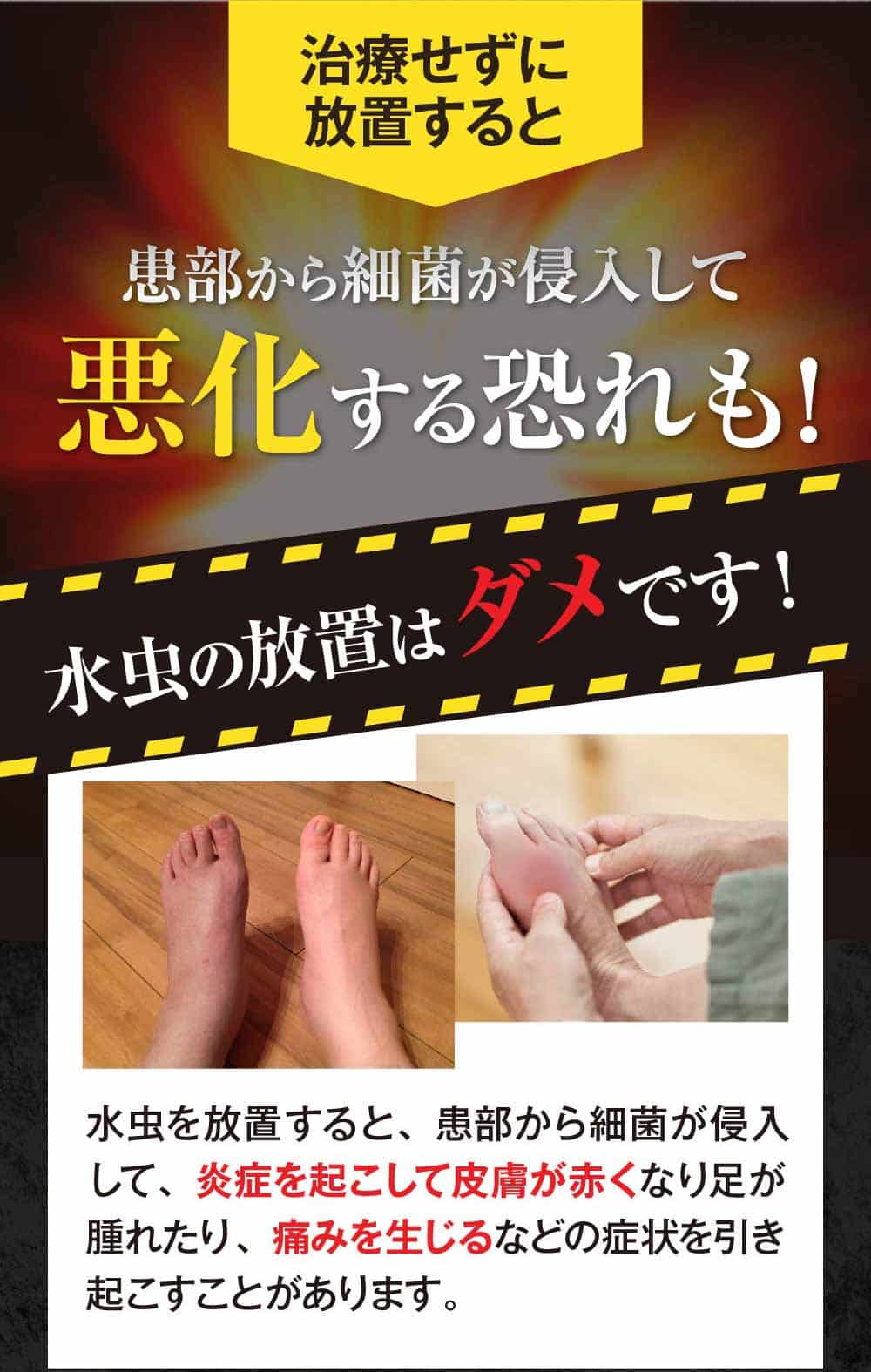 水虫を放置すると重症化する恐れも！