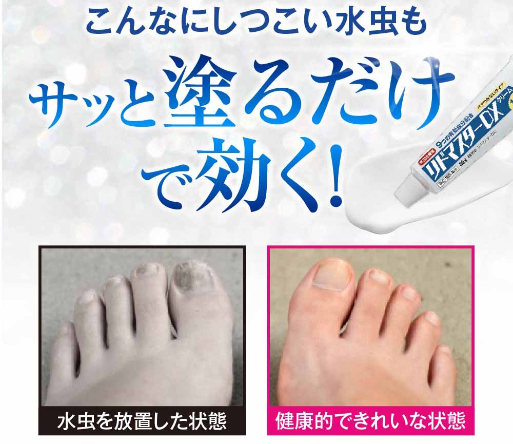 さっと塗るだけで水虫に効く