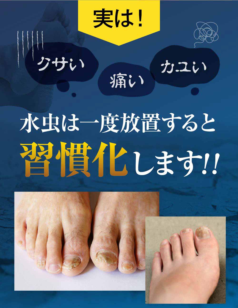 水虫は一度放置すると習慣化します