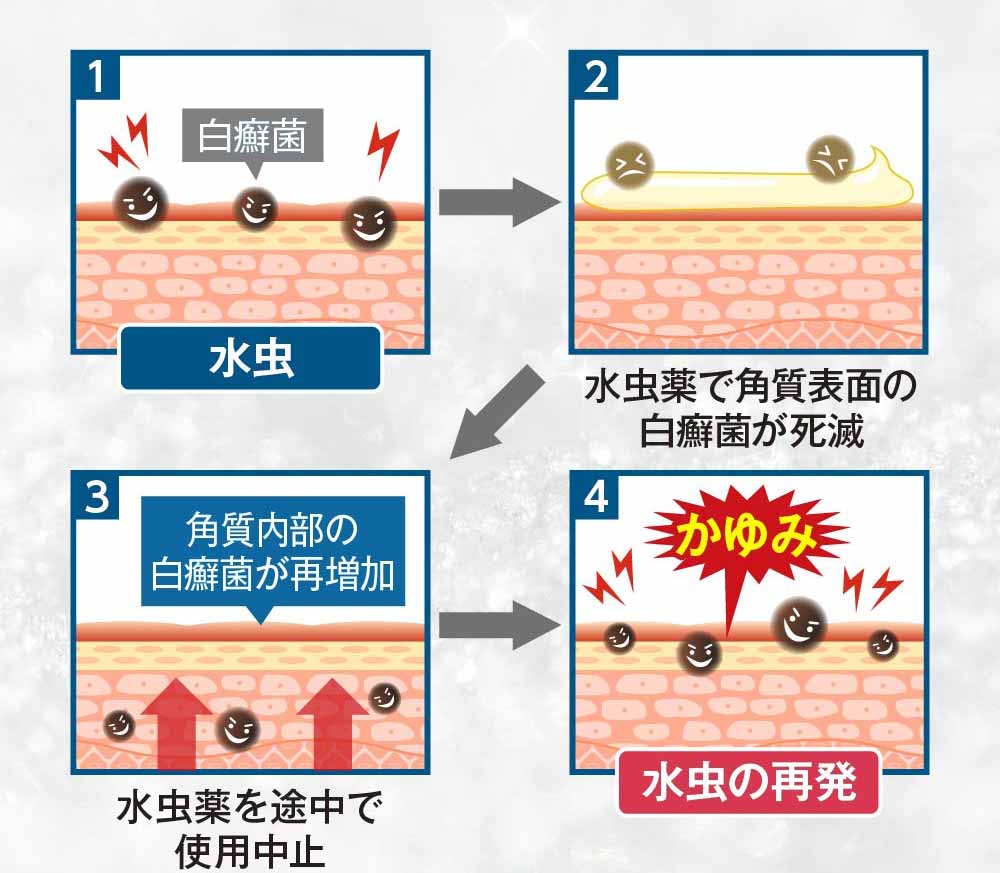 水虫は再発しやすい病気です！