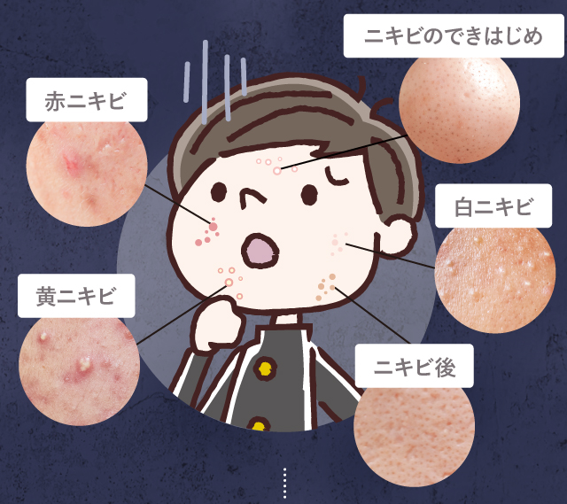 ニキビのできはじめ 赤ニキビ 黄ニキビ 白ニキビ ニキビ後