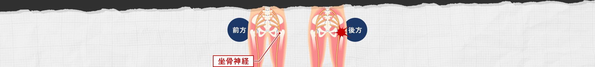 坐骨神経イメージ①
