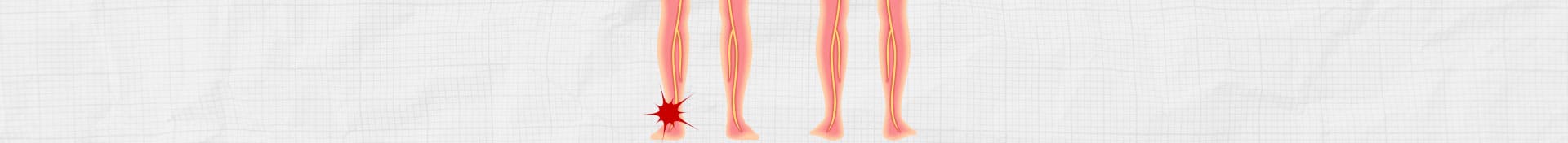 坐骨神経イメージ②