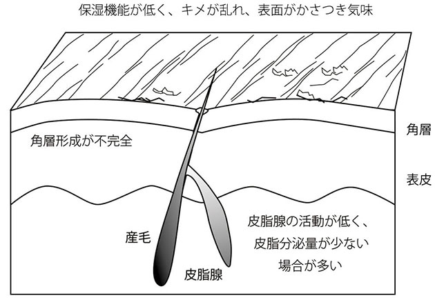 敏感肌の肌モデル図