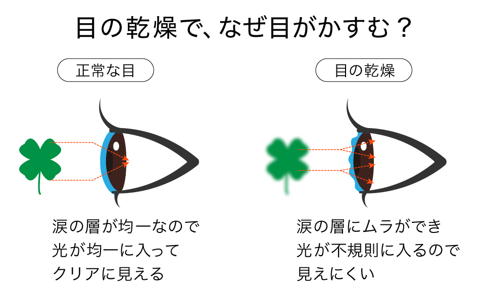 目の乾燥でかすみ目が生じる仕組み（涙の層のムラと光の入り方）